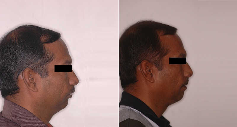 Genioplasty Surgery in Pune