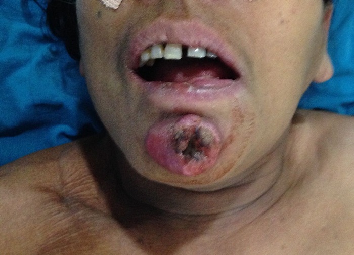 Oral cancer treatment in Pune
